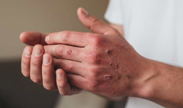 Skin Picking Symptoms